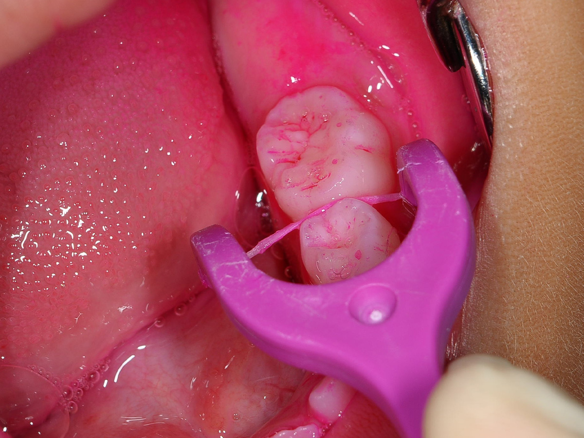 フロスで歯と歯の間の汚れもしっかり落とします