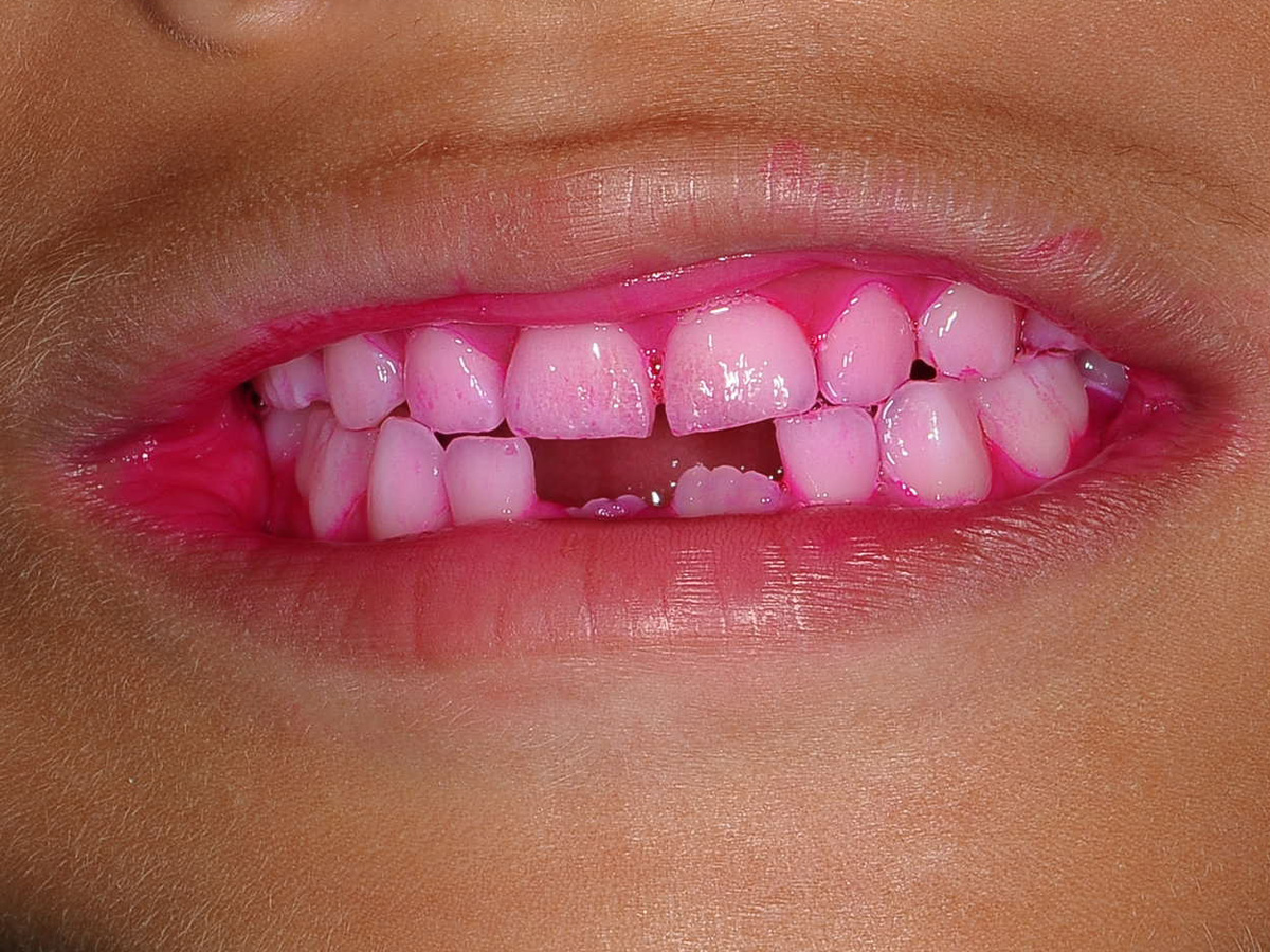 染出し剤で磨き残しを染出します