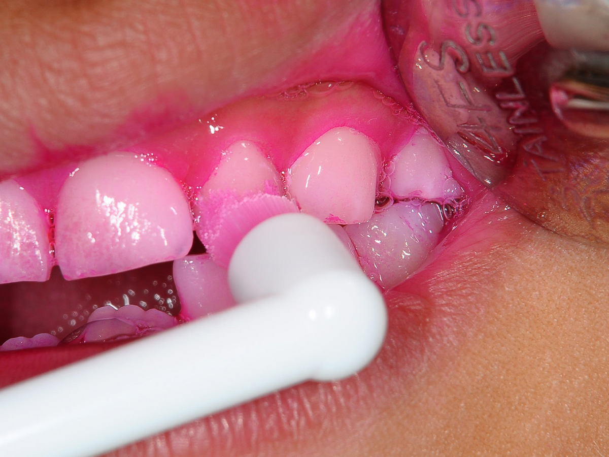 歯ブラシが届きにくい場所はタフトブラシも使用します