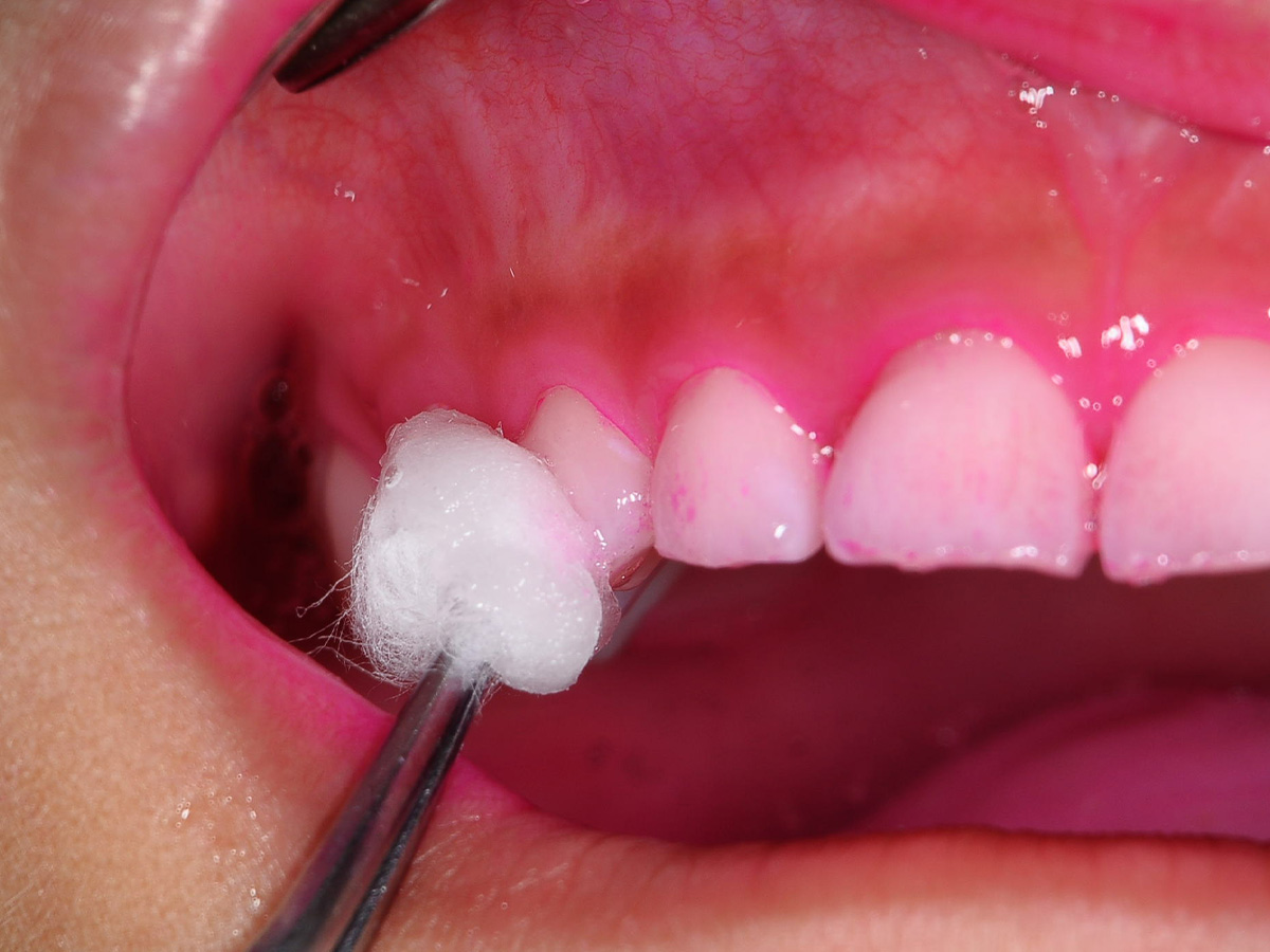 フッ素塗布で強い歯質をつくります